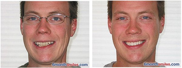 6 Month Smiles