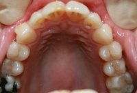 Invisalign Upper Arch After