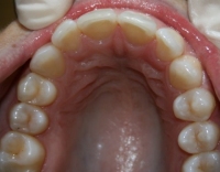 Invisalign Upper Arch After